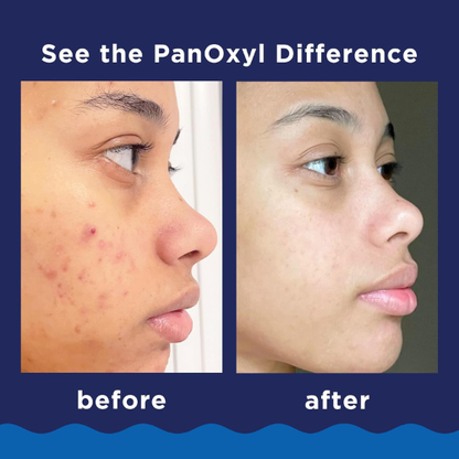 PanOxyl Acne Foaming Wash – 10% Benzoyl Peroxide 5.5 oz