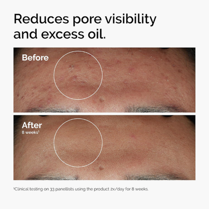 The Ordinary Niacinamide 10% + Zinc 1% | Oil Control & Pore Refining | 30ml